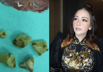 Pengangkatan Kantong Empedu Maia Estianty Berakhir Baik, Istri Irwan Mussry Tunjukkan 5 Batu Empedu Besar yang Selama Ini Menyarang di Tubuhnya, Ngeri!