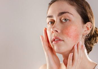 Jenis Makanan Penyebab Jerawat yang Sebaiknya Dihindari, Simak Yuk!