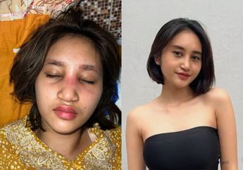 'Panik Banget!' Rasakan Nyeri hingga Bengkak di Hidungnya, Selebgram Permesta Dhyaz Harus Kembali Jalani Operasi Pengambilan Implan karena Infeksi