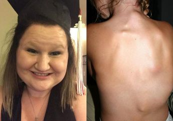 Mengidap Sindrom Langka, Wanita ini Alami Kelainan Hingga Seluruh Tubuhnya Berubah Menjadi Batu