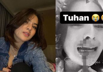 Bercak Merah Merembet di Tubuhnya, Iqlima Kim Ngaku Menderita Penyakit Misterius
