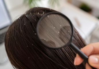 Jangan Dianggap Sepele! Ketahui Penyebab dan Cara Mengatasi Ketombe