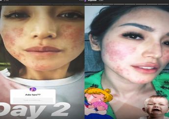'Semenjak Tragedi Muka..' Ngeri! Wajah Jessica Iskandar Rusak Sampai Harus Berhenti Sementara dari Pekerjaan