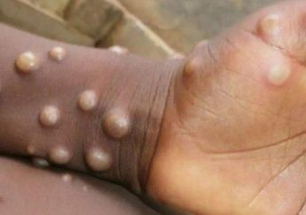 Ditetapkan sebagai Darurat Kesehatan Global oleh WHO, Ini Gejala Cacar Monyet yang Berhasil Diidentifikasi, Ternyata Bisa Menular Lewat Kontak Fisik!