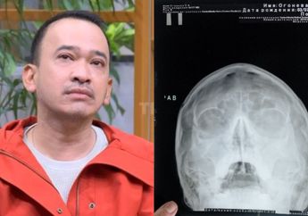 Ruben Onsu Idap Empty Sella Syndrome, Kenali Gejala Penyakit Langka yang Menyerang Otak, Apakah Bisa Sembuh?