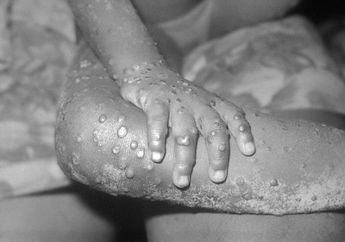 Gawat! WHO Tetapkan Cacar Monyet Sebagai Darurat Kesehatan Dunia, Mulai Sekarang Wajib Kenali Gejala dan Cara Pencegahannya