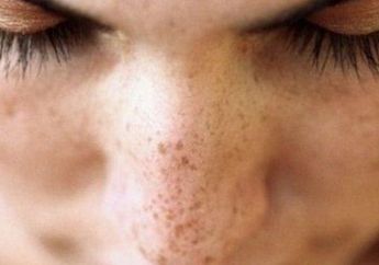 Nyesel Banget Baru Tahu! Ternyata 6 Tips Ini Efektif Memudarkan Flek Hitam dengan Cepat, Simak Yuk!