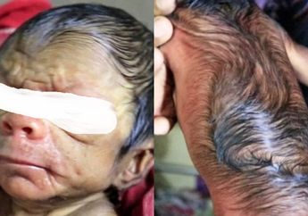 Terlahir dengan Sindrom Langka hingga Disebut Hanya Bisa Bertahan 13 Tahun, Kelahiran Bayi Ini Bikin Geger Satu Ruang Bersalin!
