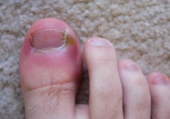 6 Cara Alami Atasi Cantengan karena Infeksi. Lakukan Sebelum Parah!