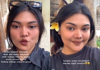Viral Seorang Wanita Alami Lumpuh di Separuh Wajahnya Gegara Kipas Angin hingga Idap Penyakit Bell's Palsy, Begini Kronologi Selengkapnya!