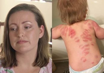 Pulang dari Tempat Penitipan Anak, Ibu ini Histeris Melihat Tubuh Bayinya Dipenuhi 25 Bekas Gigitan