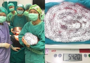 Ukurannya Lebih Besar dari Bayi Baru Lahir, Pengangkatan Tumor di Perut Pria 52 Tahun Ini Bikin Dokter Merasa 'Senang', Ternyata Inilah Alasannya!