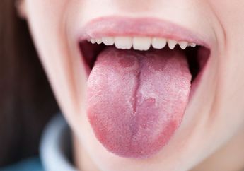 Waspada! Bintik-bintik Putih Pada Lidah Bisa Jadi Tanda Penyakit Ini Bersarang di Mulut, Jangan Tunda Periksa ke Dokter