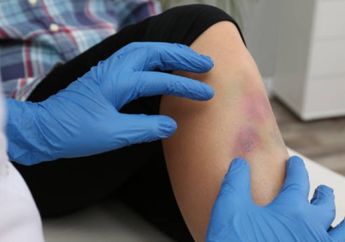 Cari Jawaban Kelas 4 SD Tema 5, Inilah Ciri-ciri Luka Memar dan Cara Mengobatinya yang Mudah