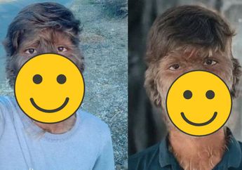 Wajahnya Penuh Bulu sampai Diledek Mirip Monyet, Remaja Ini Pasrah Idap Sindrom Manusia Serigala, Begini Kisahnya