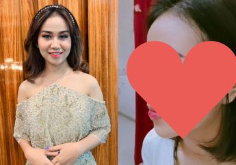 Mayang Adik Vanessa Angel Lepas Perban, Begini Bentuk Hidung Barunya Usai Oplas, Doddy Sudrajat Puas: Natural!