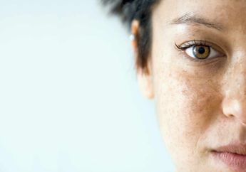 Punya Melasma di Kulit Wajah? Singkirkan Segera dengan Cara Ini!