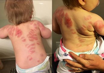 Anaknya Pulang dengan 25 Bekas Gigitan, Orang Tua Syok Saat Tahu Kejadian di Tempat Penitipan Anak