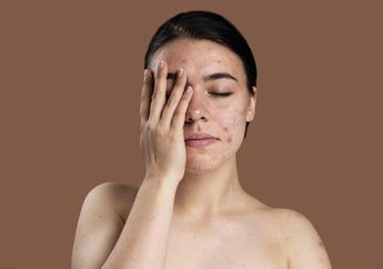 5 Tips Hidup Atasi Jerawat Hanya dengan Ubah Kebiasaan Sehari-hari, Salah Satunya Dilarang Pencet Jerawat!