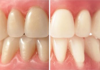Cara Ampuh Memutihkan Gigi Kuning Cuma dengan Baking Soda Dicampur Lemon, Cuma Butuh Dipakai Seminggu Sekali