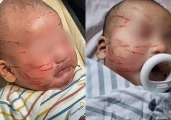 Wajah Bayi Penuh Cakaran Setelah Pulang dari Tempat Penitipan Anak, Ibu Syok Tahu Fakta ini