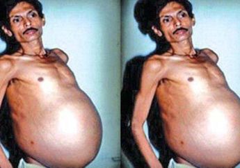 Dijuluki Pria Hamil, Lelaki Ini Ternyata Mengandung Kembarannnya Sendiri Selama 36 Tahun, sang Dokter Syok Ungkap Fakta Aslinya!