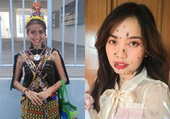 Wajah Dipenuhi Tahi Lalat, Gadis ini Viral Setelah Mengikuti Ajang Miss Universe, Kini Raih Prestasi Membanggakan