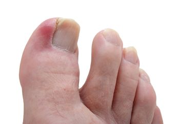Tanpa Ke Dokter! Ini Cara Menghilangkan Nyeri Cantengan di Jempol Kaki