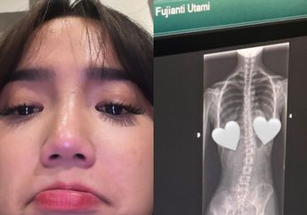 Mata Berkaca-kaca, Fuji Unggah Foto Rontgen Tulangnya yang Miring, Mantan Thariq Halilintar Ramai Didoakan Sembuh, Ada Apa Gerangan?