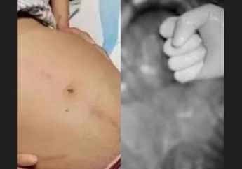 YA ALLAH Nyawa Wanita ini Terancam Usai Tak Bisa BAB Selama 10 Hari, Kondisi Tubuh Makin Kurus sampai Ditemukan ini di Perutnya