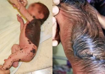 Bayi Terlahir dengan Kondisi Tak Lazim Bikin Ruang Persalinan Geger, Terungkap Penyebabnya