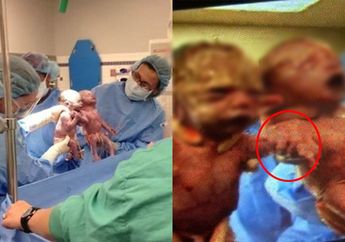 Bayi Kembar Viral, Saat Dilahirkan Lakukan Hal ini Sampai Bikin Dokter Tercengang