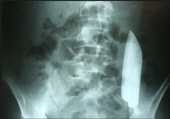 Ngaku Sakit Perut, Pria Ini Kaget Bukan Kepalang Saat Pisau 15 Sentimeter Ditemukan di dalam Perutnya, Ternyata Ini Penyebabnya