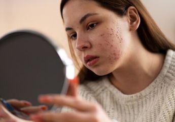 5 Arti Mimpi Jerawatan, Hati-hati Jangan Gampang Iri dengan Orang Lain!