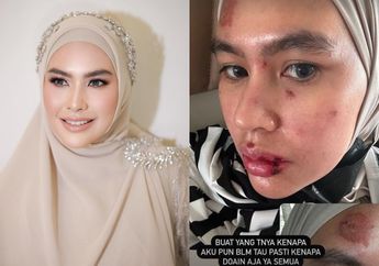 INNALILLAHI, Kartika Putri Unggah Foto Wajah dan Lidahnya Melepuh, Istri Habib Usman Minta Doa