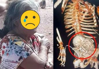 Astaghfirullah, Hamil Sejak 50 Tahun Lalu, Nenek Ini Syok Baru Tahu Ada Janin di Perutnya, Kondisinya Sudah Membatu