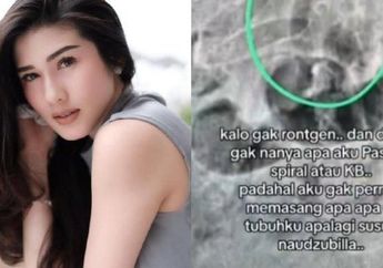 Geger Benda Diduga Jarum 10 cm Ditemukan di Tubuh Stevie Agnecya hingga Muncul Dugaan Santet, Dokter Buka Suara dan Ungkap Lokasinya