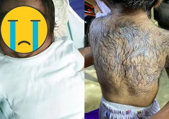 Ibu Muda Merana Bayinya Penuh Bulu Bak Manusia Serigala, Diduga Kena Kutukan Gegara Makan Kucing Saat Hamil, Dokter Ungkap Hal Ini