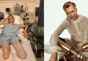 Gara-gara Pembalut, Gadis Cantik Ini Kehilangan Kakinya hingga Diamputasi, Kini Malah Bernasib Mujur Jadi Model Profesional!