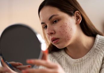 Cara Hilangkan Jerawat Batu, Pakai Tips Rumahan sampai Daftar Bahan Aktif yang Ampuh!