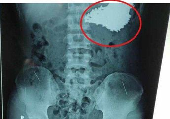 Geger, Dokter Temukan 70 Paku Bersarang di Perut Seorang Pria Asal Indramayu, Pasien Diduga ODGJ