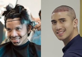 Mengenal Prosedur Transplantasi Rambut yang Dilakukan Verrel Bramasta Hingga Attar Halilintar