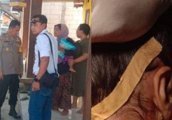 Nasib Malang Balita di Gresik Usai Digigit Monyet Liar, Luka Parah hingga Dapat 40 Jahitan
