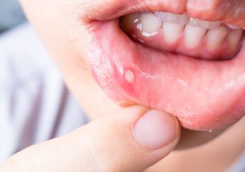 4 Tips Redakan Sariawan, Biar Nggak Makin Parah!