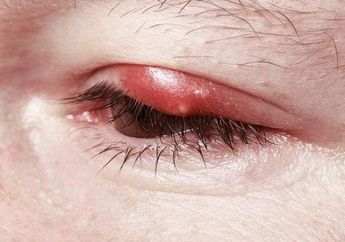 5 Arti Mimpi Mata Bintitan Jangan Dianggap Remeh, Simbol Stres dan Kelelahan