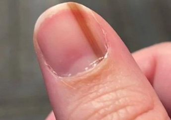 4 Arti Mimpi Kuku Berdarah Jangan Disepelekan, Akan Kehilangan Kontrol sampai Kelelahan