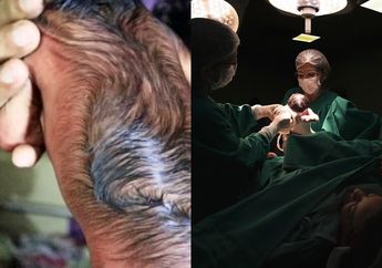 Bayi Baru Lahir ini Bikin Syok Ruang Persalinan, Wajah Mirip Kakek-Kakek dan Tubuh Berbulu Lebat