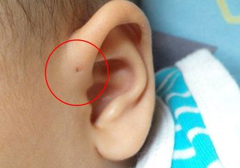 Punya Lubang Kecil di Telinga? Ini Penyebab dan Bahayanya yang Jarang Diketahui!