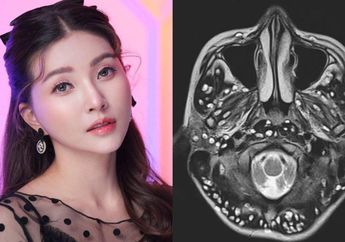 Kenali Gejala Kista Batang Otak Seperti yang Diidap Sarwendah, Ternyata Ada Banyak Jenisnya