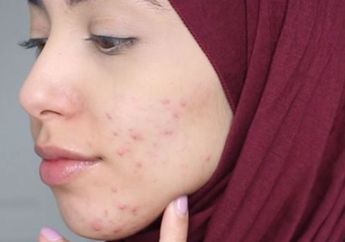 8 Tips Cegah Jerawat untuk Wanita Berhijab, Pilihan Hijab Penting Banget